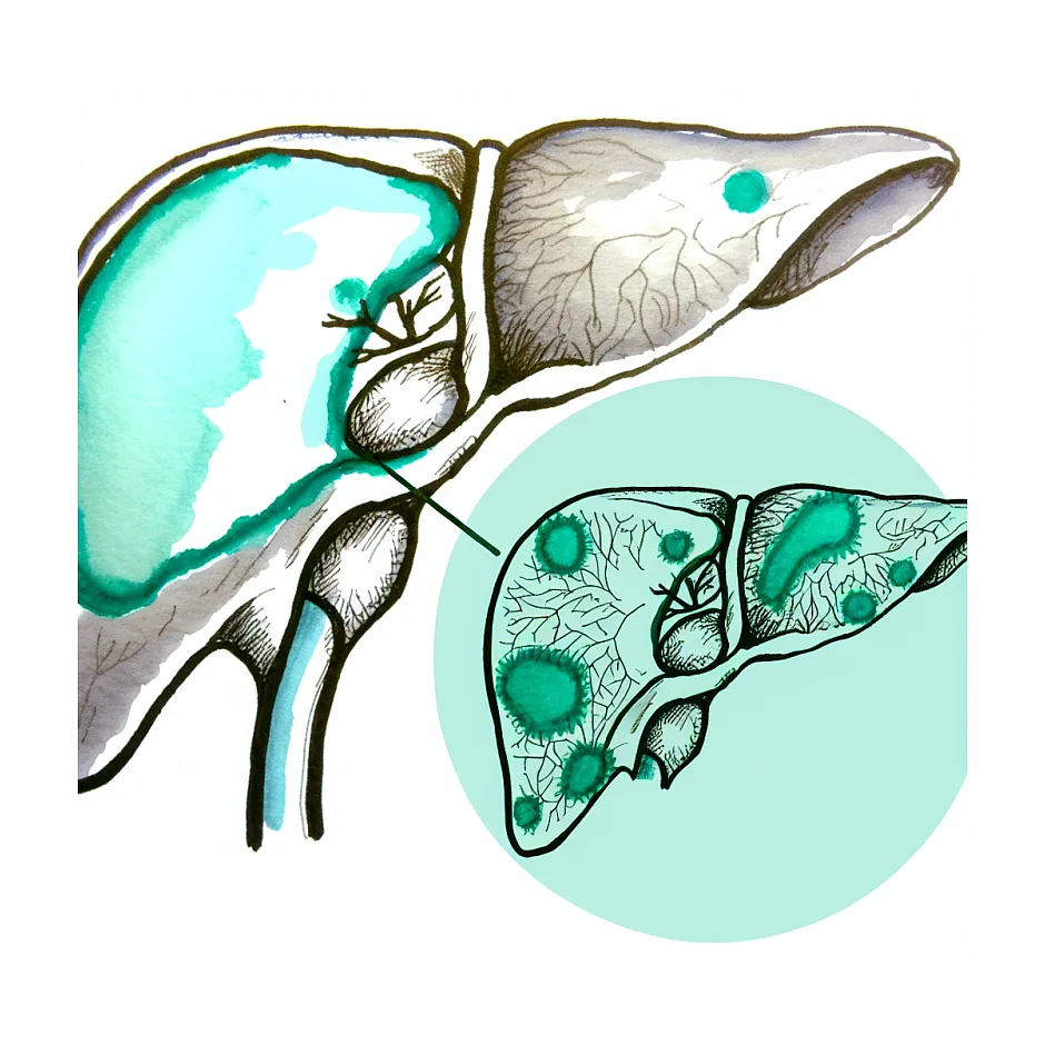 درمان تب مالت و پیشگیری از عود