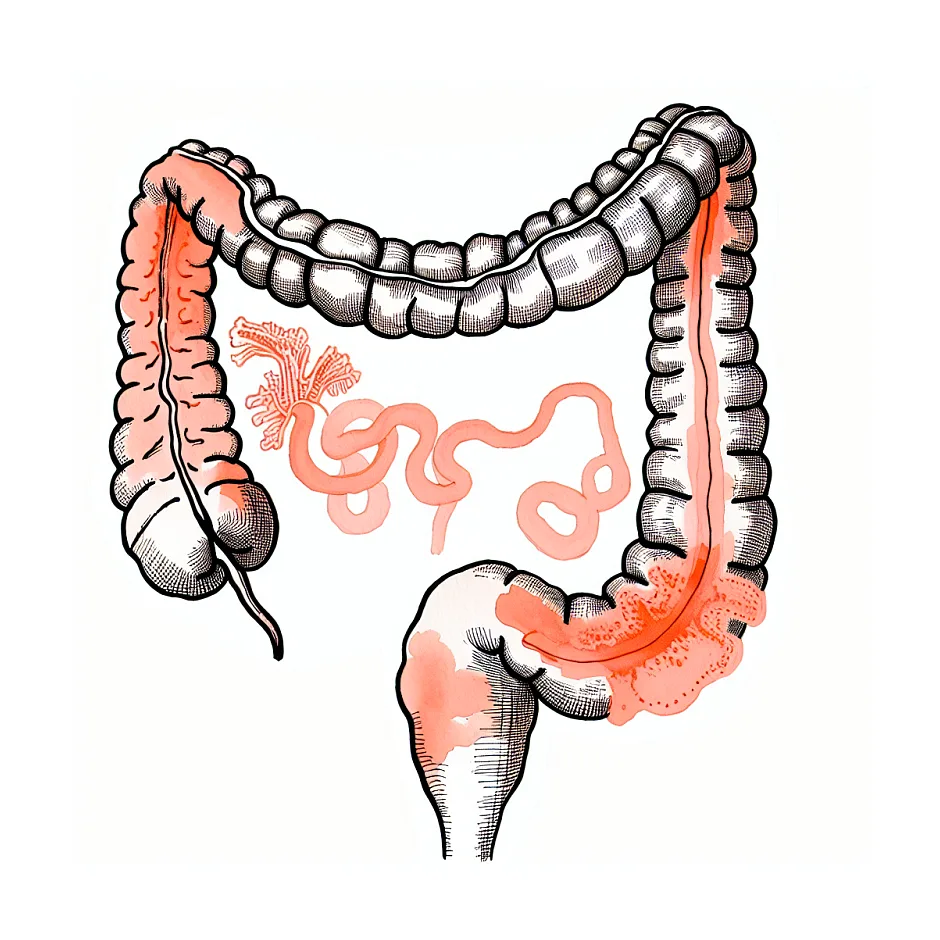 روزه گرفتن در سندرم روده تحریک‌پذیر