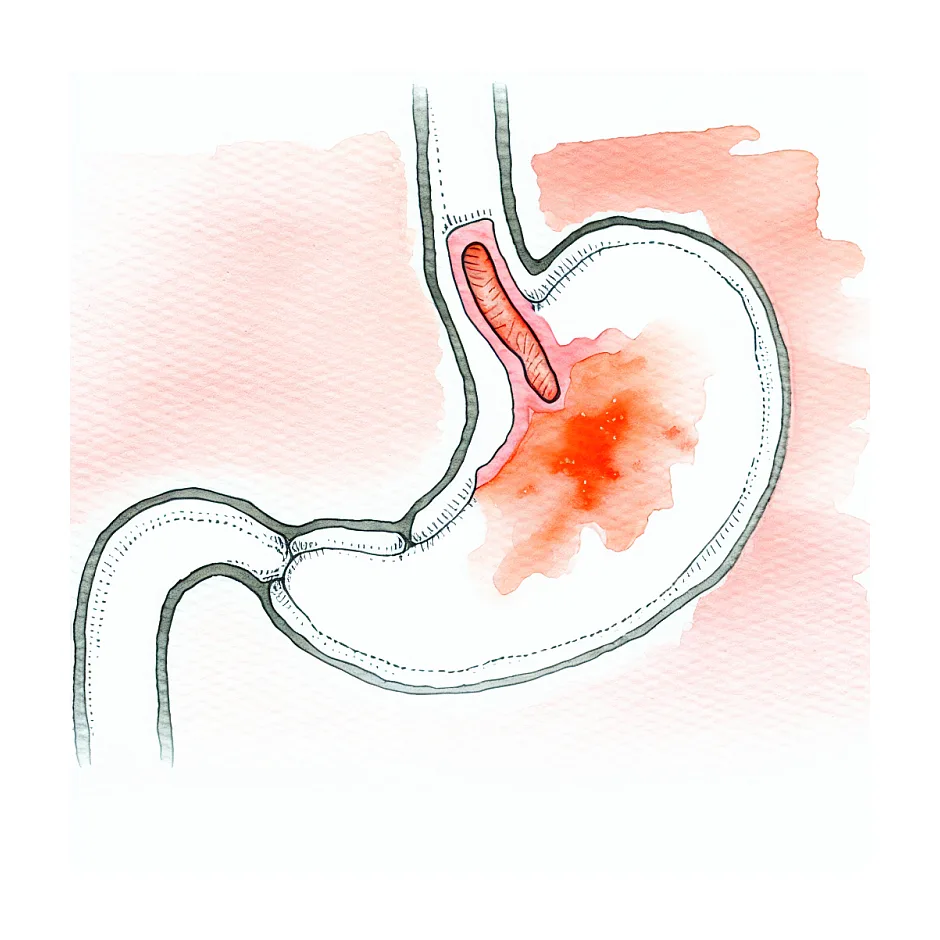 علت داغ شدن و گرگرفتن معده همراه درد چیست؟